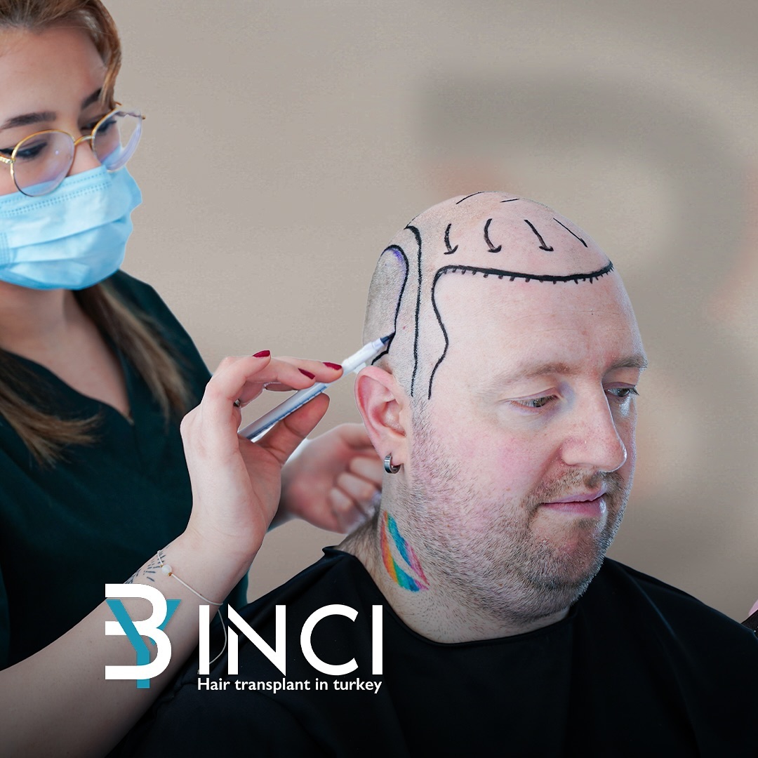 .
#hair #hairstyle #hairtransformation #hairtransplant #hairtransplantturkey #saç #saçekimi #saçekimiistanbul #fue #sapphire #dhi